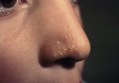 Жировики на носу ждут применения мази Витаон